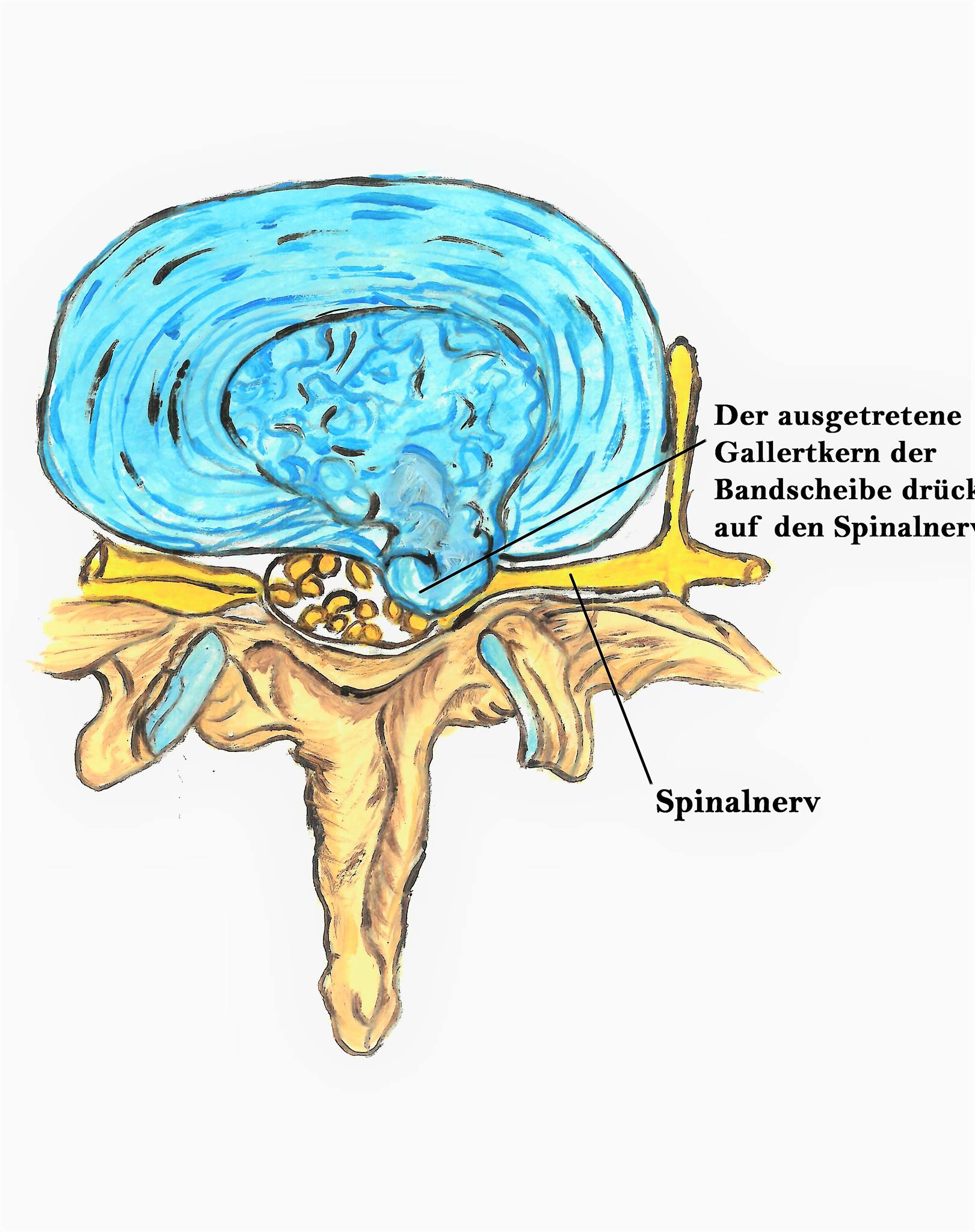 Kurz Wissenswertes über die neuropathischen Schmerzen